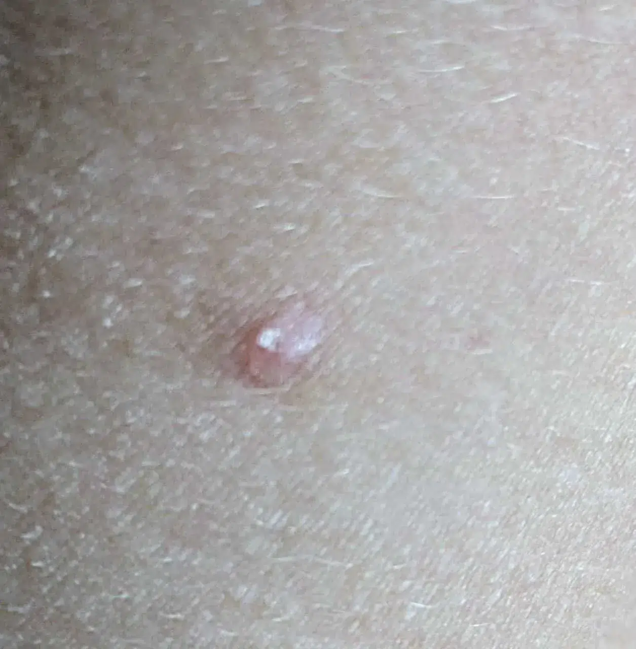 Molusco contagioso infantil en torso, se aprecian las características con su forma central umbilical