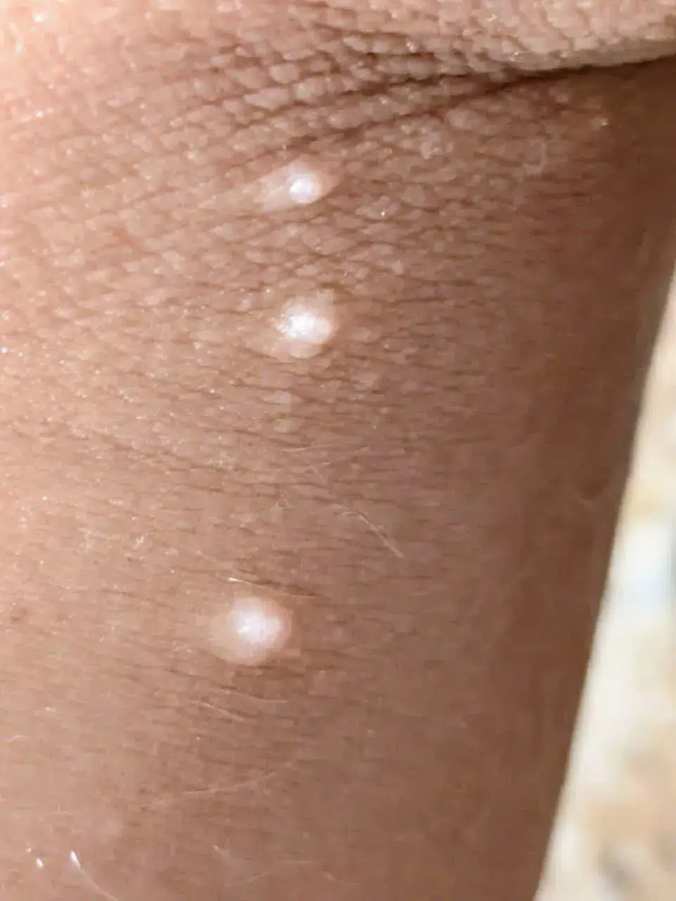 molusco contagioso en niños detectado en pierna