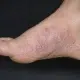 Pie de atleta