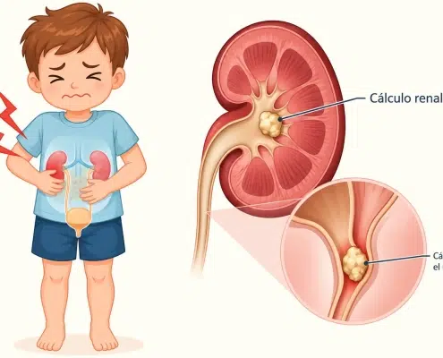 Cálculos renales en niños